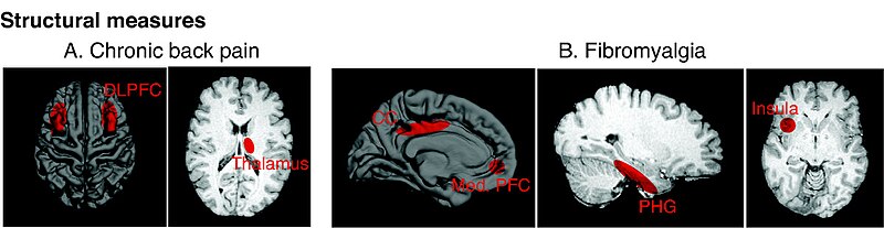 File:Schematic Examples of CNS Structural Changes in chronic pain.jpg