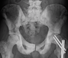 Sclerosis of the bones of the pelvis due to prostate cancer metastases