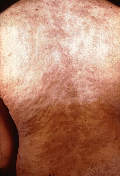 Secondary syphilitic rash Treponema pallidum 6756 lores