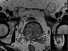 MRI (done for another purpose).