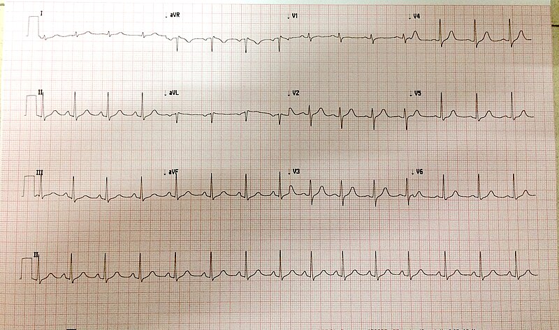 File:10sec-ekg-12-lead.jpg