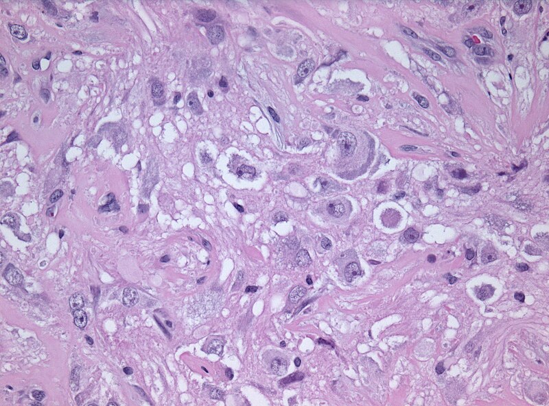 File:Anaplastic ganglioglioma HE.jpg