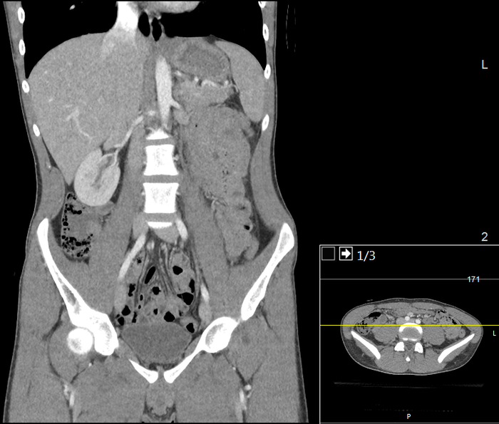 CT of a normal abdomen and pelvis, coronal plane 64.png