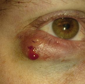 chalazion treatment in iran