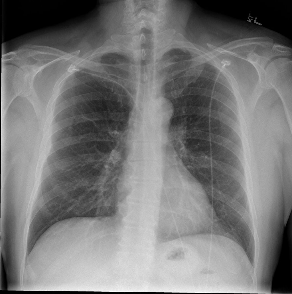 1024px-Chest_x-ray_-_posteroanterior_view