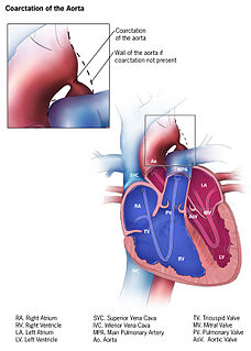 Coarctation of the aorta congenital condition whereby the aorta is narrow, usually in the area where the ductus arteriosus (ligamentum arteriosum after regression) inserts.