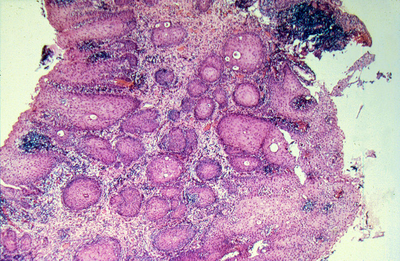 File:Diethylstilbestrol (des) cervix (70).jpg