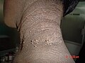 Familial acanthosis nigricans3.jpg