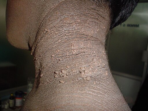 Familial acanthosis nigricans3