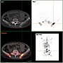 Vorschaubild für Neuroendokriner Tumor