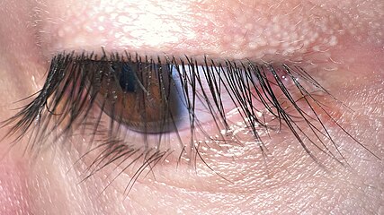 Long, thick, and dark eyelashes are considered an attractive facial feature as they draw attention to the eyes. Subject exhibits trichomegaly (exceptionally long lashes)