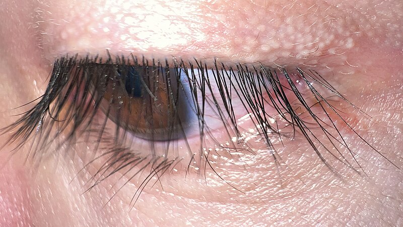 Eye muscle repair - series—Procedure: MedlinePlus Medical Encyclopedia