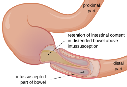 Intussusception EN