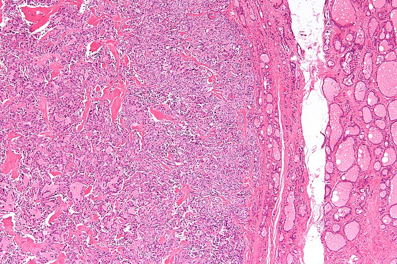 File:Medullary thyroid carcinoma - low mag.jpg