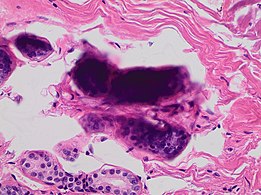 Stacking of cells on top of each other gives a dark look, and in this breast tissue it may mimic microcalcifications.