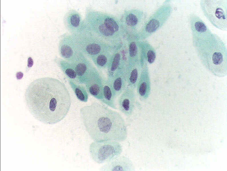 File:Pap test atropy.JPG