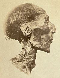 segített múmia a prosztatitisben