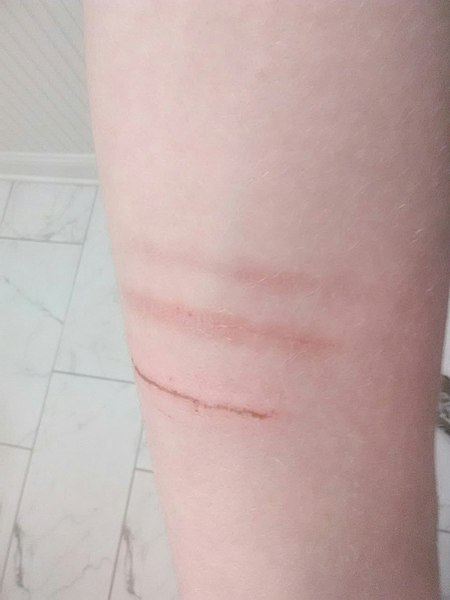 File:Self-injury cuts and scars on forearm.jpg
