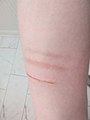 Self-injury cuts and scars on forearm.jpg