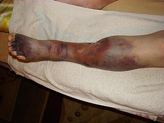 <span class="mw-page-title-main">Post-thrombotic syndrome</span> Medical condition