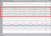 Brain wave patterns and activity recorded by an electroencephalogram. Sleep EEG Stage 1.jpg