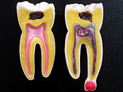歯のモデル