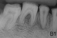 X-ray showing lack of enamel opacity and a pathological loss of enamel in patient with amelogenesis imperfecta Amelogenesis.jpg