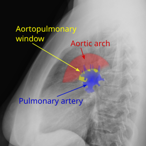 Aortopulmonary window.svg