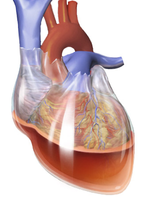 <span class="mw-page-title-main">Hemopericardium</span> Medical condition