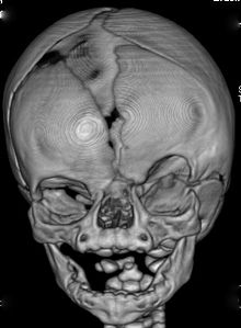 CT-scan of the skull of a patient with coronal synostosis, orbital hypertelorism, and facial asymmetry as part of craniofrontonasal dysplasia. CFND CT-scan.jpg