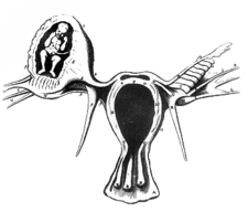 Ektopické těhotenství na ilustraci Reiniera de Graafa
