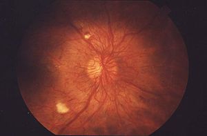 Fundus Proliferative retinopathy EDA01.JPG