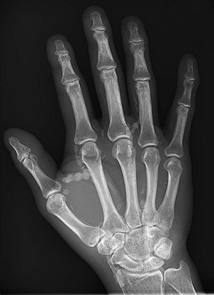 Hand radiograph showing tumoral calcinosis.jpg