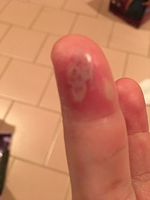 are warts on hands herpes)