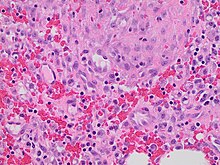 Histopathology of granulation tissue at 11 days after injury, showing fibroblasts, hemorrhage and lymphocytes. Histopathology of biopsy site at 11 days, high magnification.jpg