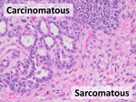 Thumbnail for Carcinosarcoma