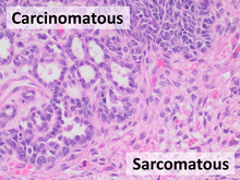 Micrograph of a carcinosarcoma of the ovary. H&E stain, showing both carcinomatous and sarcomatous elements Histopathology of carcinosarcoma, annotated.png