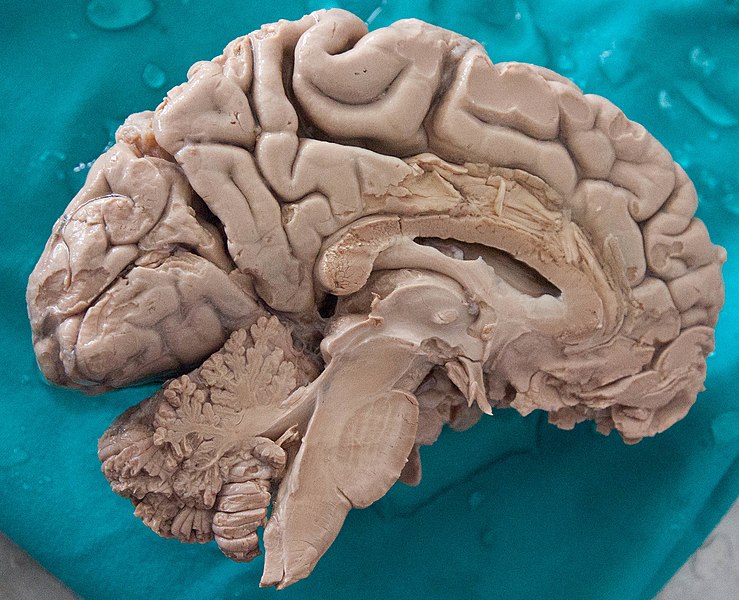 File:Human Brain Dissected.jpg