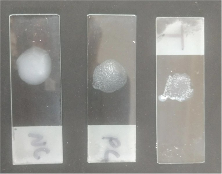 File:Latex agglutination test positive for melioidosis.jpg