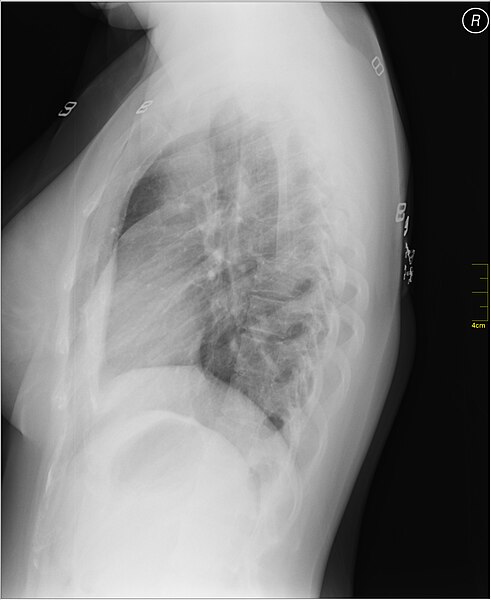 File:Medical X-Ray imaging XCC07 nevit.jpg