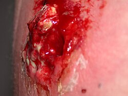 Mrsa cyst exploded.jpg