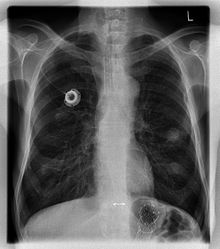 Chest X-ray showing an implanted port Portkatheter Rontgen.JPG