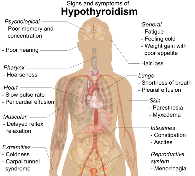 File:Signs and symptoms of hypothyroidism.png