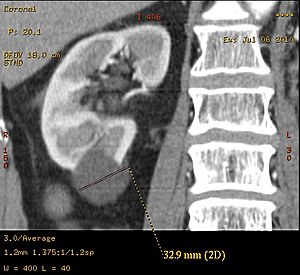 Қарапайым бүйрек cyst.jpg