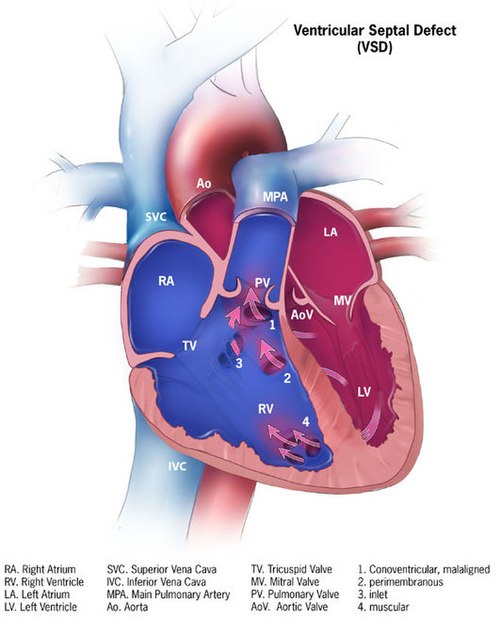 Открыт vsd. Межжелудочковая перегородка сердца. Ventricular Septal defect. Базальный отдел межжелудочковой перегородки.