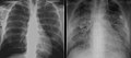 X-ray of ground glass opacities of pneumocystis pneumonia.jpg