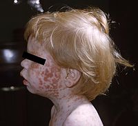 Young boy displaying the characteristic maculopapular rash of rubella[16]