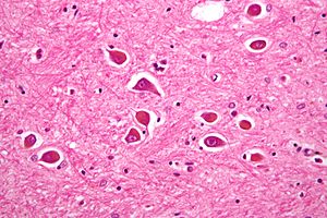 Alzheimer type II astrocyte high mag.jpg