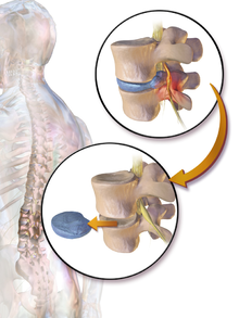 Illustration depicting a surgical discectomy Blausen 0319 Discectomy.png