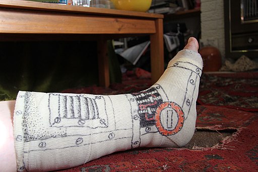Broken ankle- Cast detail